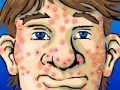 Game Acne Be Gone